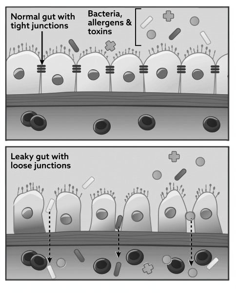 Leaky_gut_syndrome Kopie Ist Gluten schlecht für uns?